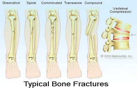 Illustration of typical bone fractures, e.g., greenstick, spiral, comminuted, transverse, compound, and vertebral fracture.